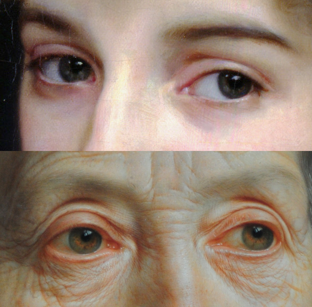 Yellowing Of Sclera With Age